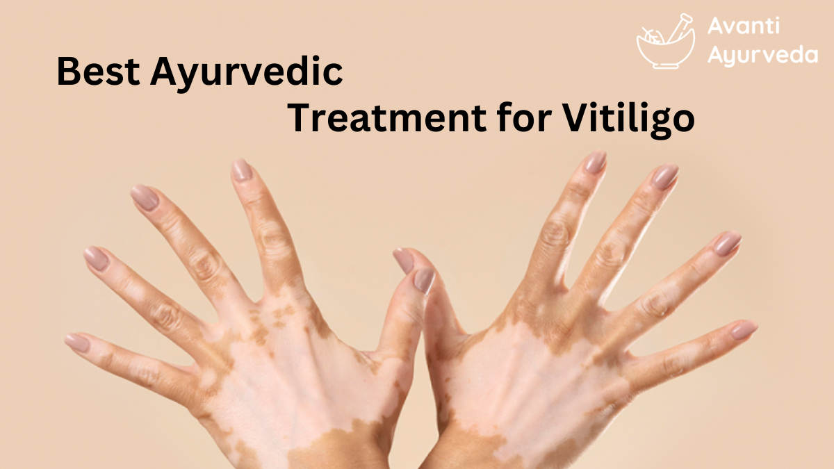 Best Ayurvedic Treatment for Vitiligo