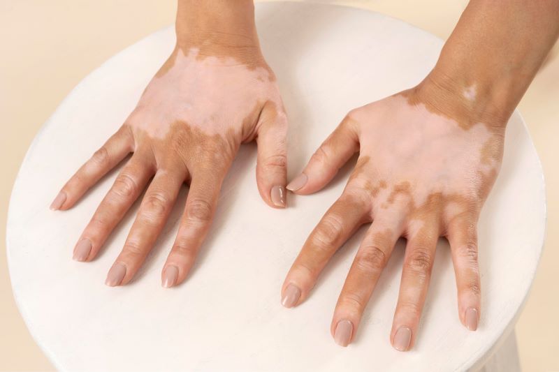 Vitiligo Treatment